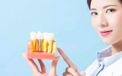 Dental Implants 101: Everything You Need to Know