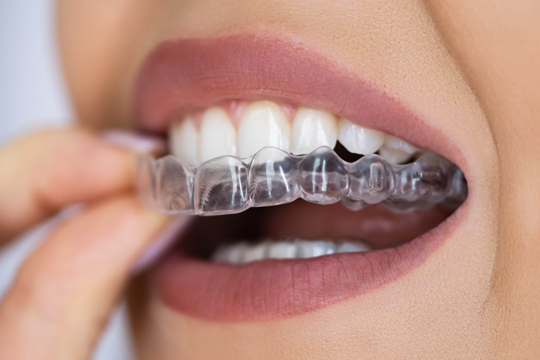 Invisible Braces in Gurugram